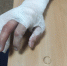 Астраханские спасатели помогли мужчине снять кольцо со сломанной руки - Астрахань 24